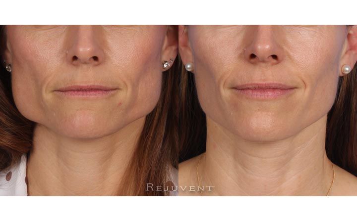 Youthful Skin: Xeomin in Plano, Texas