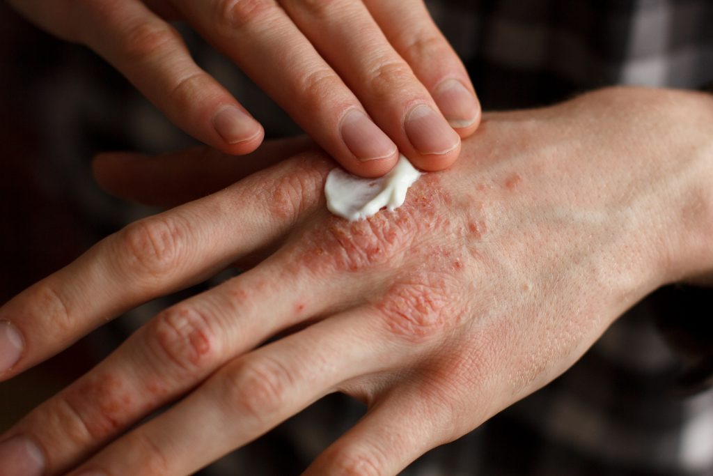 How to treat allergic contact dermatitis?