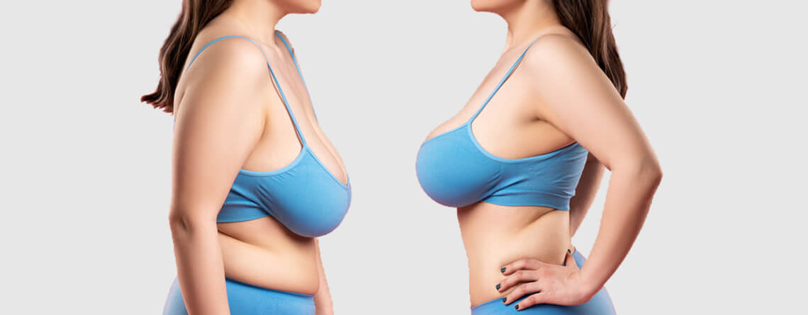 Ultimate Guide to Breast Lift Surgery in Dubai
