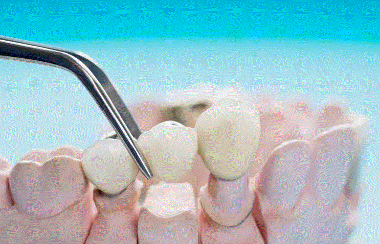 Considering a Dental Bridge? Here’s What You Need to Know